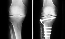 OP-Knie-Verschleiss
