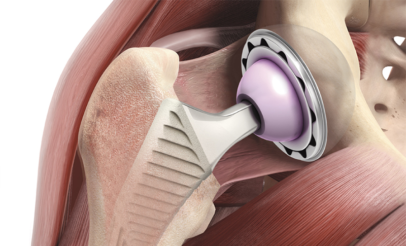 Hüftgelenks-Prothese | Orthopraxis München-Gräfelfing