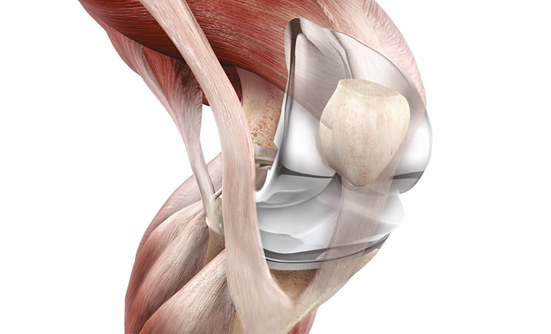 Kniegelenks-Prothese | Orthopraxis München-Gräfelfing